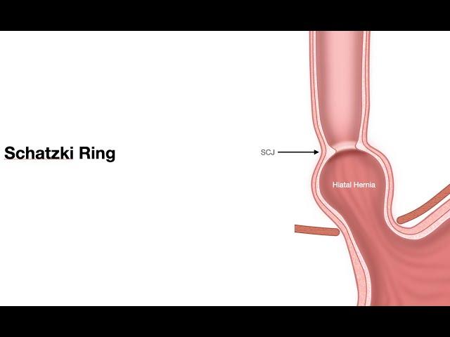 ECE-Lesson 2f5-Pathology of Esophagus-Schatzki ring