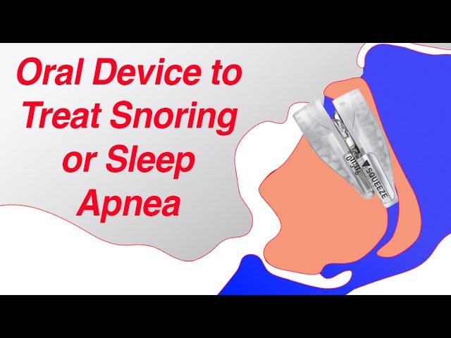 Mandibular Advancement Device (MAD) to Treat Snoring and Sleep Apnea