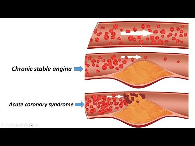 Approach to chest pain; english version