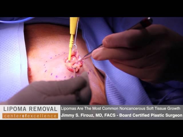 Lipoma Removal | Lipoma Surgery Performed By Dr. Firouz