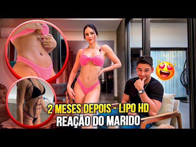 ANTES E DEPOIS RESULTADO LIPO HD  | *ele falou a real!*