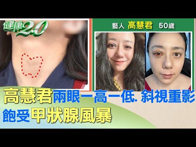 高慧君兩眼一高一低.斜視重影 飽受甲狀腺風暴 健康2.0