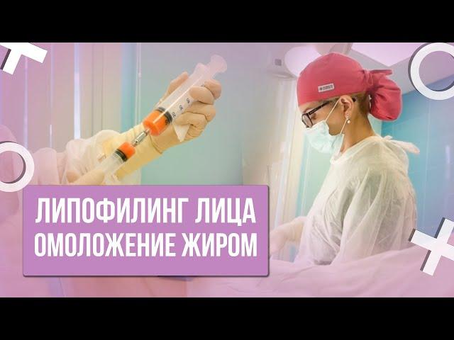 ЛИПОФИЛИНГ ЛИЦА / ОМОЛОЖЕНИЕ ЛИЦА СОБСТВЕННЫМ ЖИРОМ / РЕЗУЛЬТАТ ДО ПОСЛЕ #абриелль #кочнева