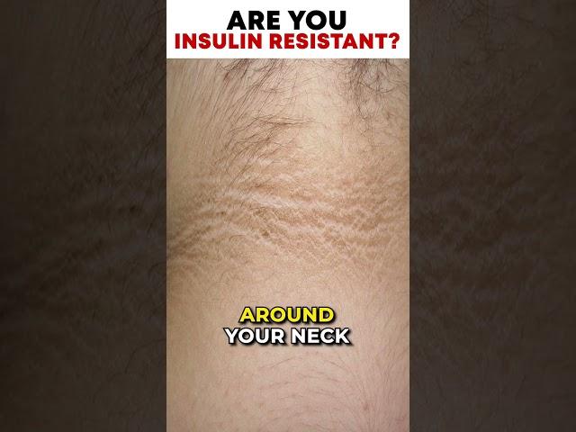 Are you Insulin Resistant? | SugarMD [Sugarmds.com]