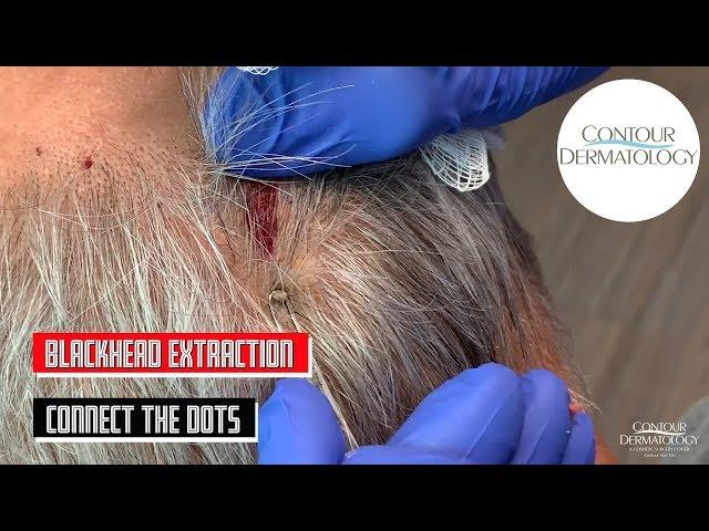 Blackheads Extraction From Behind the Head (Connect The Dots)