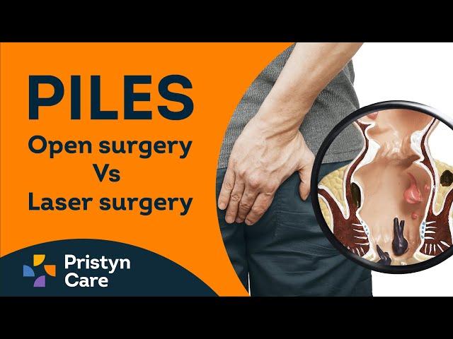 Which Piles Treatment is Better - Open Surgery or Laser Surgery? | Call : 9821388242