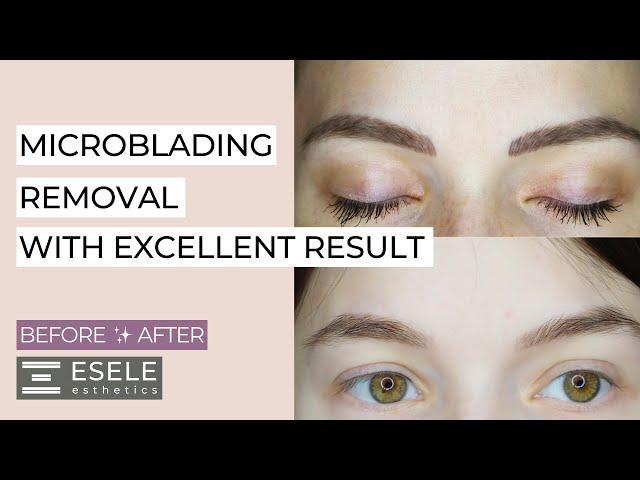 How to Remove Microblading? Tattoo Removal. Low-Quality Permanent Makeup.