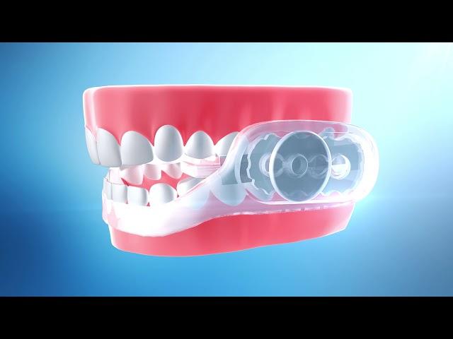 SleepRight Ultra-Comfort No-Boil Dental Guard