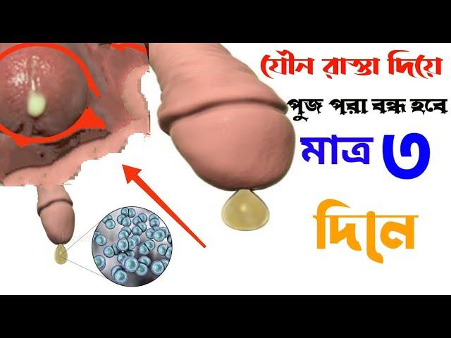 লিঙ্গ দিয়ে পুজ বের হয় কেন | লিঙ্গ দিয়ে পানি বের হয়