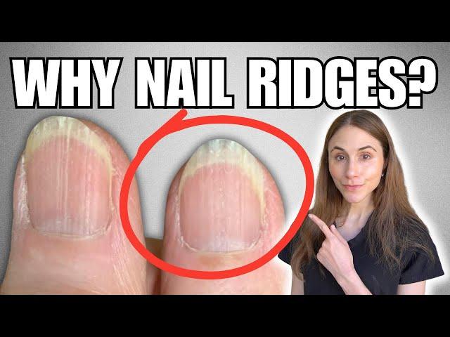 Why You Have Vertical Nail Ridges And How To Get Rid Of Them