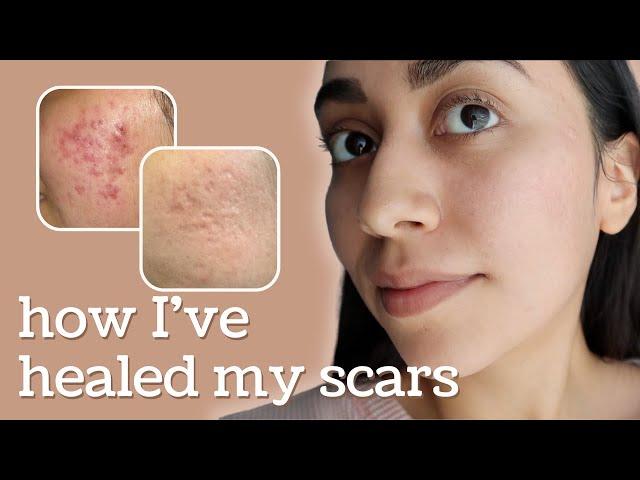 Healing Hyperpigmentation + Deep Pitted Acne Scars (this is what I’ve done)