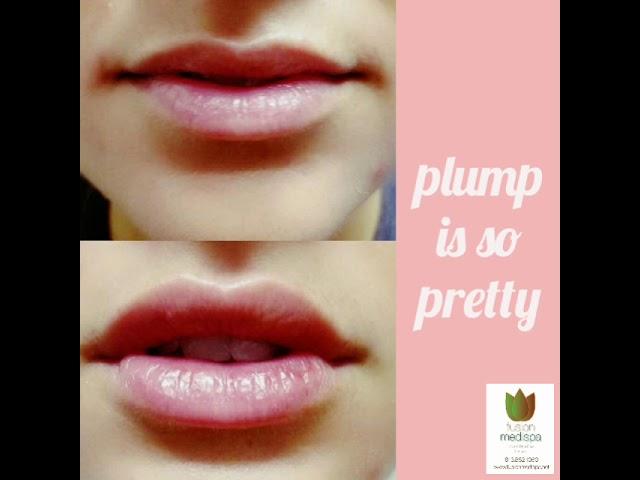 Perfect Lips with Filler at Fusion Medispa Tampa