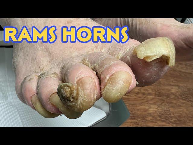 RAMS HORNS NAILS ON MULTIPLE TOES