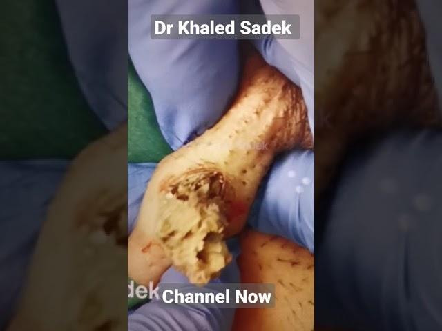 Massive armpit cyst. Dr Khaled Sadek. LipomaCyst.com #shorts