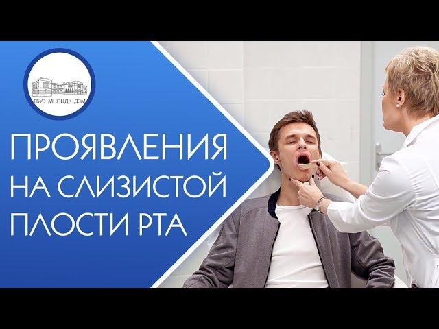  Диагностика и лечение заболеваний слизистой полости рта. Заболевания слизистой полости рта. 12+