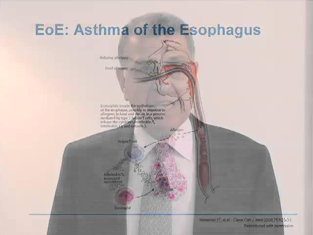 Eosinophilic Esophagitis