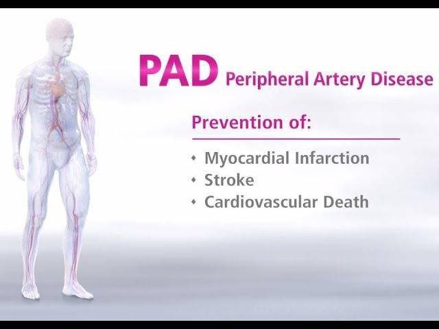 What is Peripheral Artery Disease - Mechanism of Disease