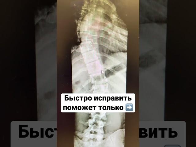 Сколиоз? #юмор #зож #сколиоз