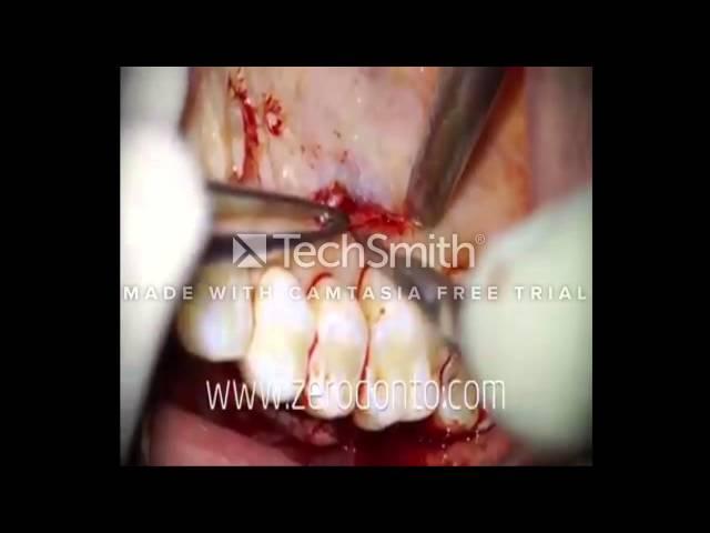 Connective tissue graft - single-incision technique