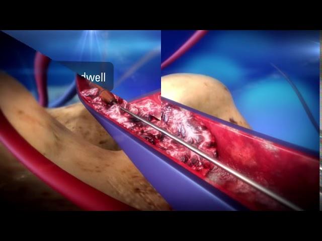 AngioJet™ Peripheral Thrombectomy System   Boston Scientific