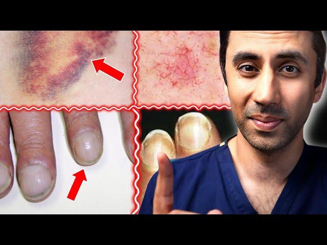 Doctor Explains 11 Skin Signs of Liver Disease / Fatty Liver / Cirrhosis