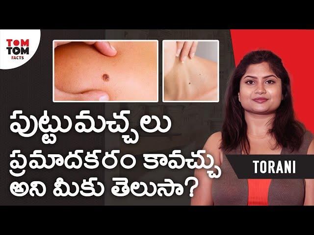 Facts About Birth Marks By Torani Makana || TomTom Facts