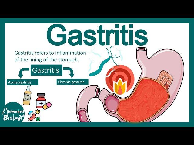 Gastritis | Pathology of gastritis | treatment of gastritis | USMLE step 1