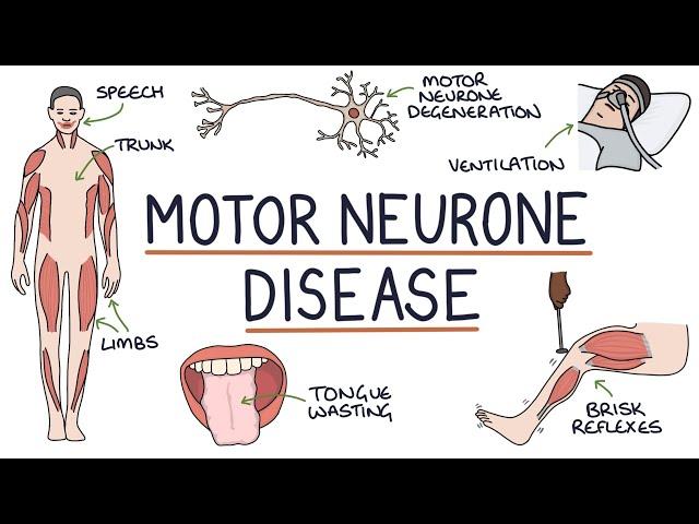 Understanding Motor Neurone Disease (Amyotrophic Lateral Sclerosis)