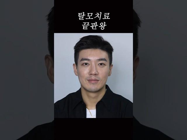 탈모치료 다 해봤는데 안된다면? #두피문신