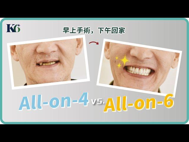 快速全口重建All-on-4 和 All-on-6 差在哪? 醫師專業分析！