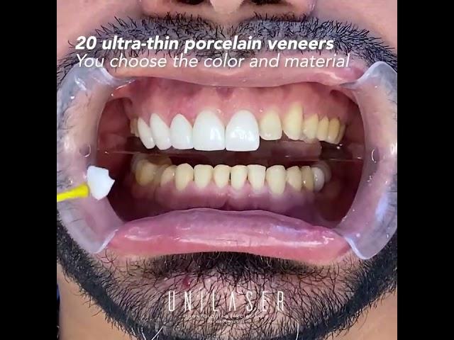 Porcelain veneers. This is how we do it