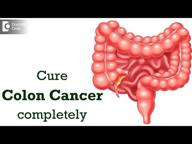 Is Colon Cancer curable? Is it easy to cure? - Dr. Parameshwara C M