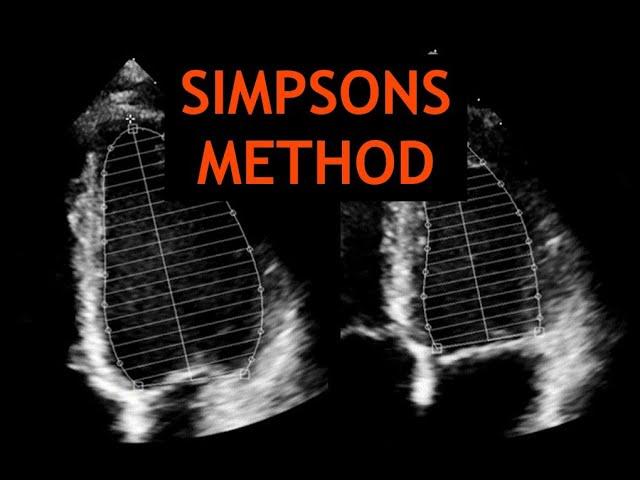 Simpsons Method: Echocardiography