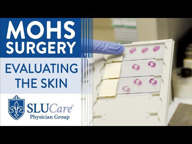 How skin is Processed and Evaluated During Mohs Surgery