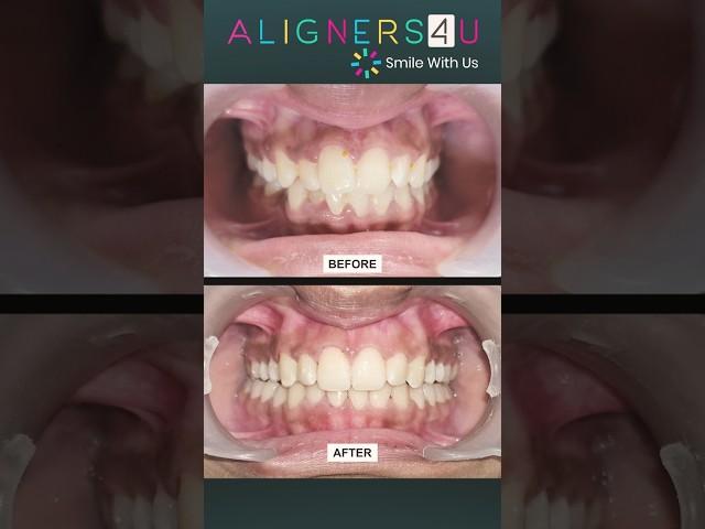 Smile Transformation Starts Here | Clear Aligners | Hyderabad | Invisible Braces | Aligners4u