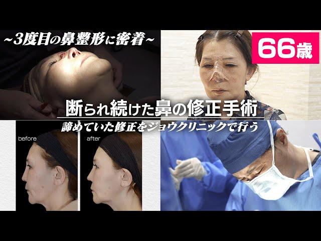 【鼻整形密着】60代女性３回目の鼻整形を決意/鼻フル修正手術