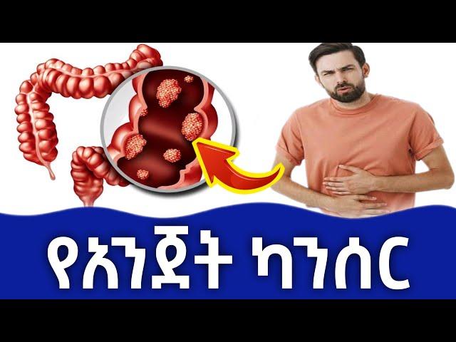 የአንጀት ካንሰር በሽታ (colon cancer) የሚከሰትበት ምክንያቶች ፣ ምልክቶቹ ፣ አጋላጭ ሁኔታዎች እና ህክምናዎቹ