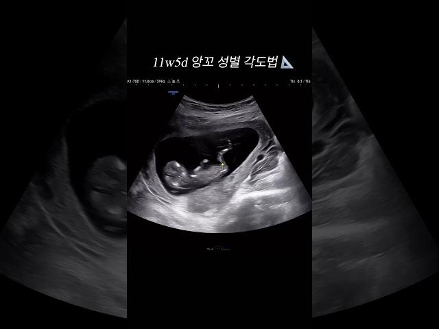 11w5d 앙꼬 성별 각도법 공주? 왕자??️️#임신11주 #태아각도법 #성별각도법 #앙꼬