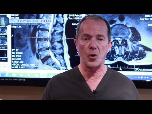 Best Way to Advance Activity after Spine Surgery by Dr. Tony Mork