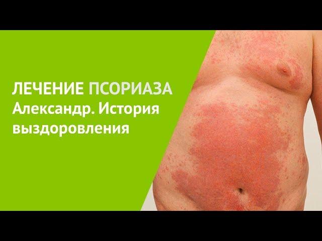 Лечение псориаза. Александр, история выздоровления