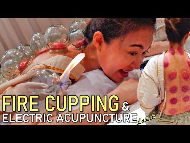 Fire Cupping & Acupuncture for Chronic Pain | ASMR soft-spoken Real Doctor consultation