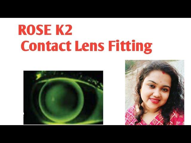 ROSE K2 Contact lens fitting basics for mild to moderate Keratoconus