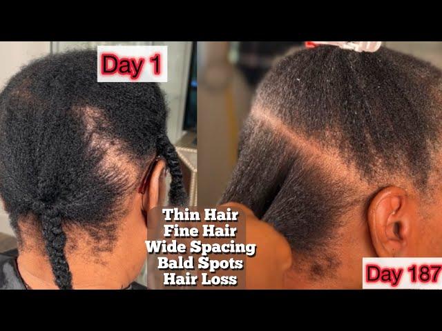 THIN HAIR PROBLEMS  Let’s fix it ! |Fine thin Hair with Bald Spots : Her 1st Year CASE STUDY