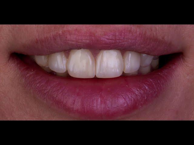 Direct Composite Veneers on a Class IV Restoration with Dr. Agne Malisaukiene