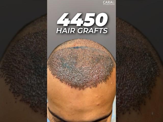 4450 Hair Grafts | Sapphire FUE Hair Transplant By Dr. Mohd Asif at CARA