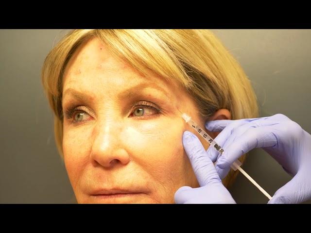 Hyaluronic Acid Fillers | Janiga MDs