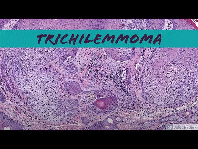 Trichilemmoma: 5-Minute Pathology Pearls