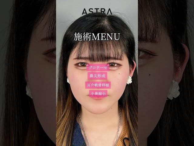 鼻フル整形ここまで変わる#アストラビューティクリニック#astrabeautyclinic #美容整形#鼻整形#忘れ鼻#垢抜ける方法