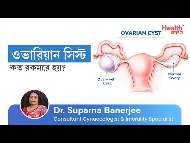 ওভারিয়ান সিস্ট - কারণ, লক্ষণ ও চিকিৎসা কি? | Ovarian Cyst - Causes, Symptoms, Types & Treatment