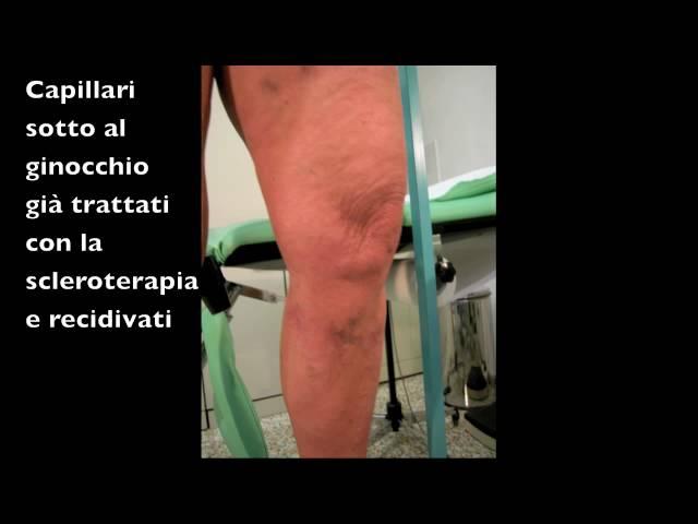 Estetica, capillari e chirurgia emodinamica - varici, vene varicose, CHIVA, veneinforma